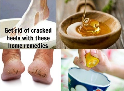 Cracked Heels Remedy | Simple Home Remedies